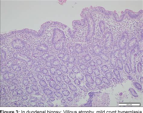 Figure 3 From The Co Occurrence Of Lichen Sclerosus Et Atrophicus And