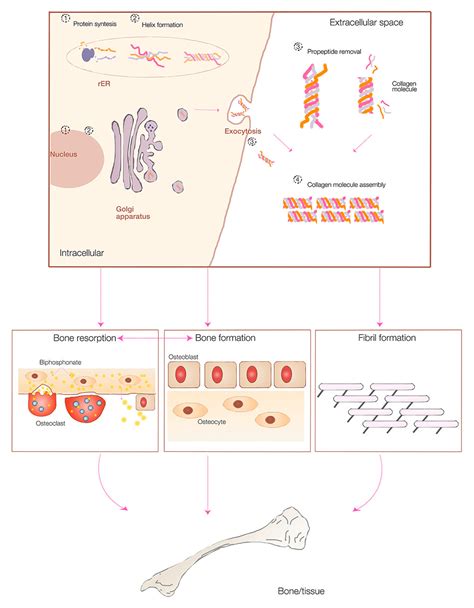 Osteogenesis Imperfecta From Diagnosis And Multidisciplinary Treatment