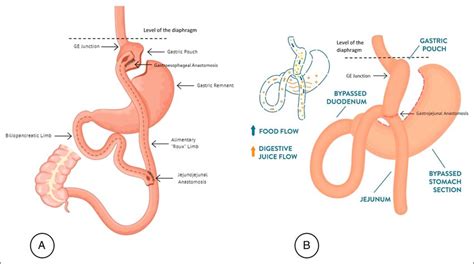 Comparison Between The A Conventional Roux En Y Gastric Bypass And Download Scientific