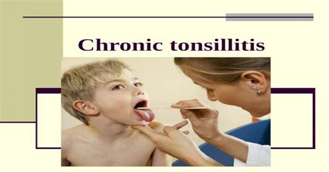 Chronic Tonsillitis Ppt Powerpoint