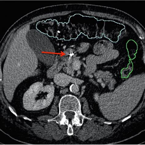 A Segmental Colonic Volume Defined On An Abdominal Ct Scan Yellow
