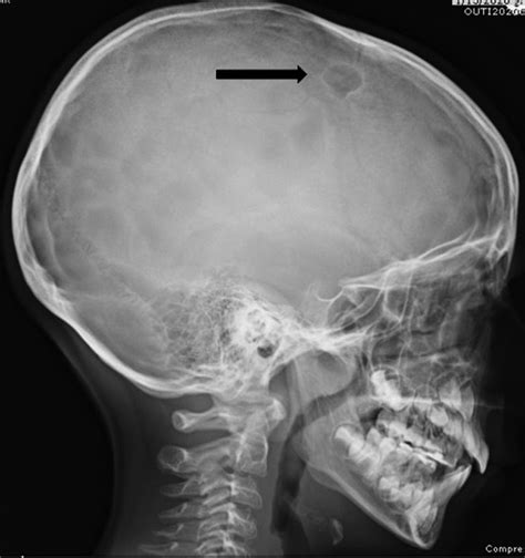 An Unusual Pediatric Case Of An Intradiploic Epidermoid Cyst With
