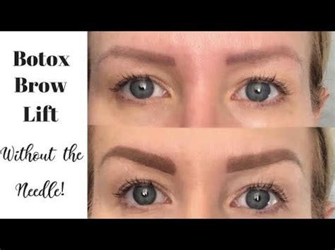 All of them are pretty simple to do and don't call for much help. Get The Look Of A BOTOX BROW LIFT Using Makeup | Full ...