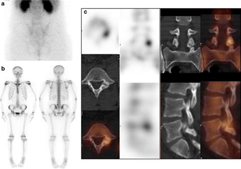 Bone Spectct Diagnosis Of Spondylolysis In An Adolescent Patient