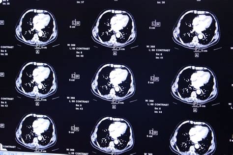 Consiguen Predecir Respuestas Al Tratamiento Del Tumor Cerebral