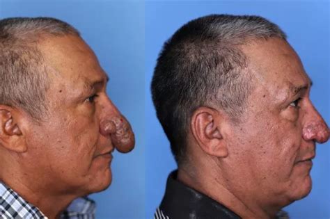 Man Who Spent Years Hiding Penis Shaped Nose Gets Miracle Surgery For