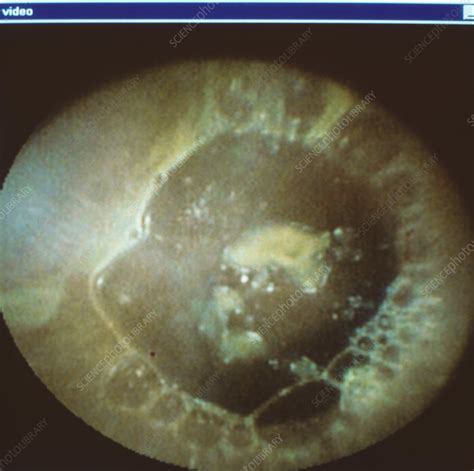 Small Intestine Endoscope View Stock Image M4400162 Science