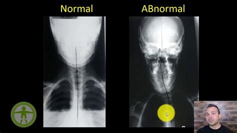 How To Understand Your Xrays Normal Vs Abnormal Spine Alignment