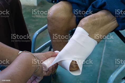 Elastic Bandaging Of Below Knee Amputation Stock Photo Download Image