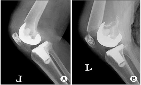 Figure 2 From Periprosthetic Fracture Following Total Knee Arthroplasty