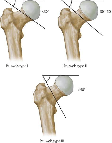 Subcapital Femoral Neck Fracture Classification