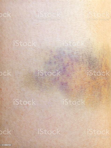 Purple Bruise Stock Photo Download Image Now Adult Beaten Up