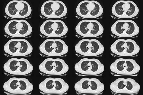 Lung Cancer Scans Are Recommended For People 50 And Older With Shorter