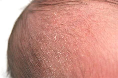 Top Home Remedies For Cradle Cap Fit Living Tips