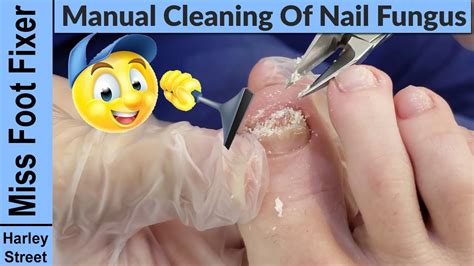 Manual Cleaning Of Nail Fungus How To Clean A Nail Fungus By Miss