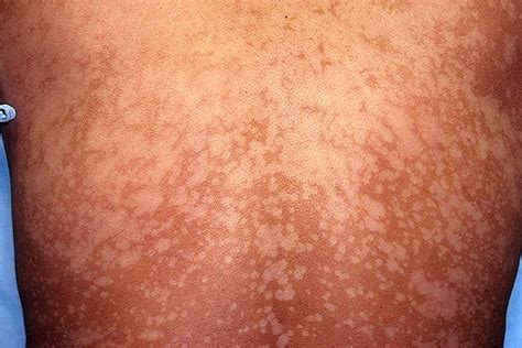 Pityriasis versicolor is a common skin complaint in which flaky discoloured patches appear mainly on the chest and back. dermatoweb.net