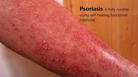 Psoriasis Is Fully Curable Using Self Healing Functional Medicine