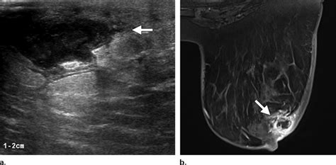 Breast Abscess In A 50 Year Old Woman With Erythema And Peau Dorange