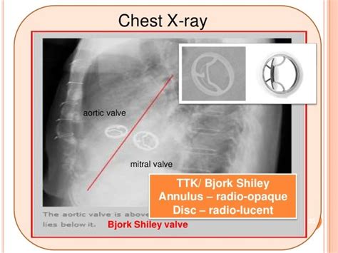 Prosthetic Heart Valves