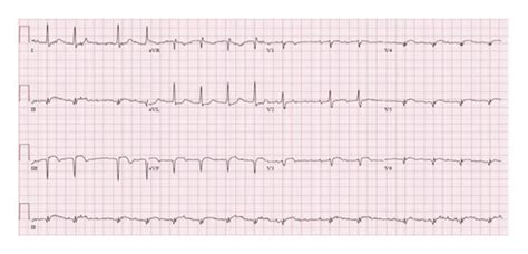 12 Lead Ekg Showing St Elevation And Q Waves In Leads Ii Iii And Avf