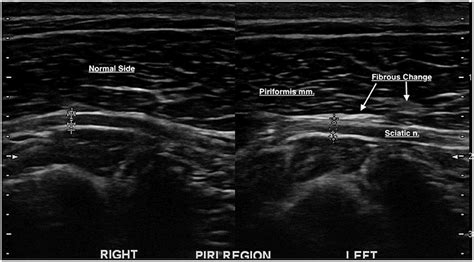 Frontiers Ultrasonography Findings In The Proximal Sciatic Nerve And