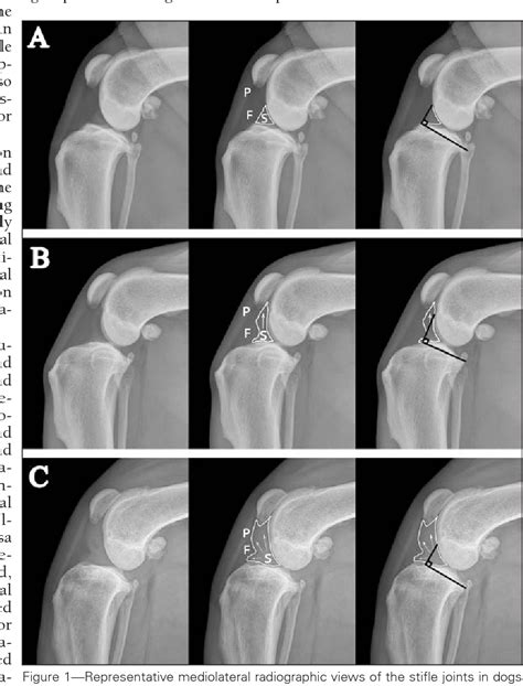 Figure 1 From Evaluation Of The Radiographic Infrapatellar Fat Pad Sign
