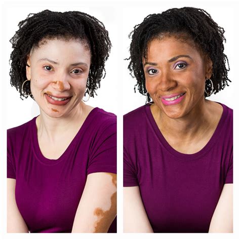 Vitiligo Makeup Concealer And Camouflage Vitiligo Vitiligo Makeup Concealer