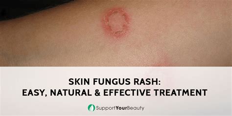 Skin Fungus Rash Easy Natural And Effective Treatment