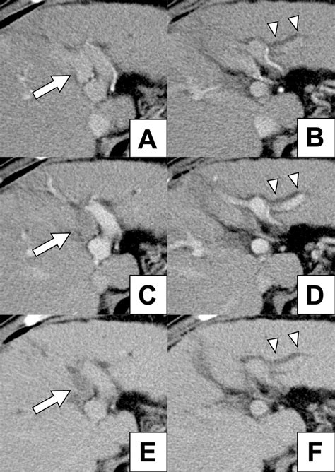 Contrast Enhanced Computed Tomography Prior To Transarterial