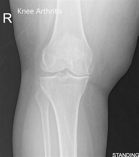 Case Study Right Total Knee Arthroplasty In 62 Yr Old Male