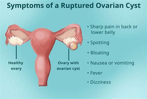 Ovarian Cyst Rupture Pain Symptoms From Burst Cyst