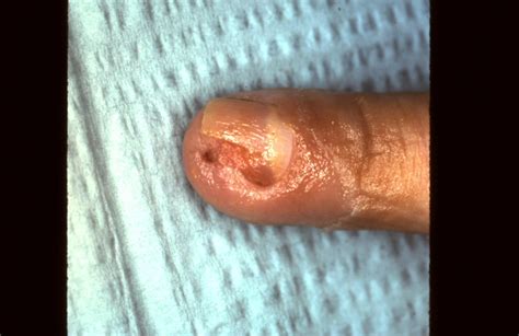 Brown Recluse Spider Bite Thumb