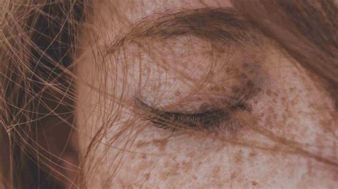 The Cost Of Laser Treatments For Freckles Exploring Factors Benefits And Risks Justinboey