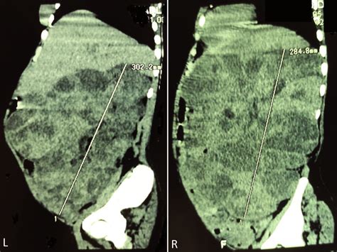 Sagittal Ct Scan Showed Two Large Kidneys Measuring 196 × 132 × 284 Mm