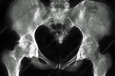 Arthritis Of The Hips X Ray Stock Image C0306253 Science Photo