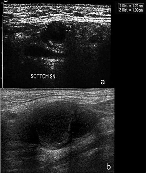 Peculiar Findings Of Pathological Lymph Nodes On Ultrasound