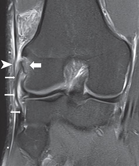 Patient Case 1 A Ap Right Knee X Ray At Day 1 Showing The Avulsion