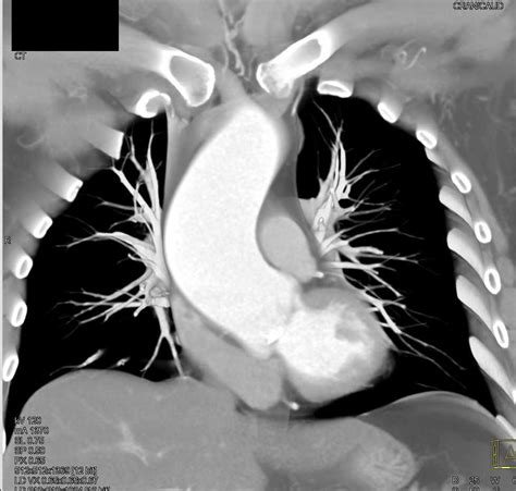 Bicuspid Aortic Valve With Early Stenosis Cardiac Case Studies