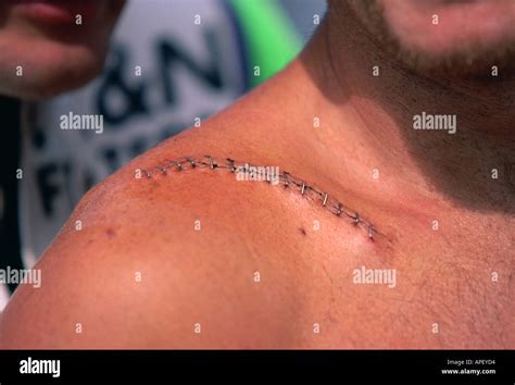 Head Wound Stitches Hi Res Stock Photography And Images Alamy