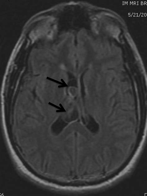 Figure 2multiple Intraventricular Neurocysticercal Cysts Treated With