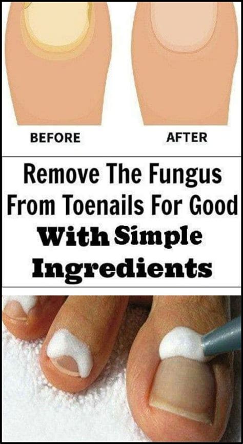 9 Simple Ingredients To Remove The Fungus From Toenails Wellness People
