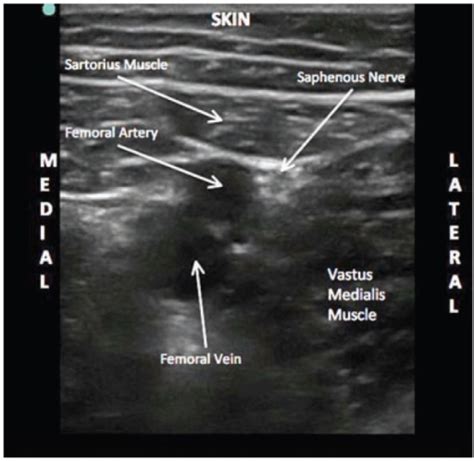 Ultrasound Image Of The Saphenous Nerve At The Mid Thig Openi