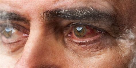 Why Cannabis Causes Red Eyes And What To Do About It Zamnesia Uk