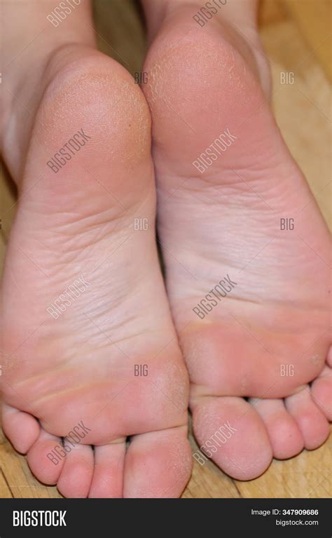 Dry Cracked Feet Image Photo Free Trial Bigstock