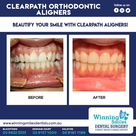Clearpath Aligners Winning Smiles Dental Surgery Winning Smiles