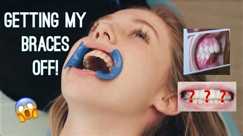 Getting My Braces Off Vlog Youtube