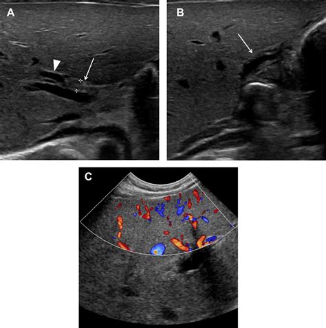 Diagnostic Performance Of Sonographic Features In Patients With Biliary