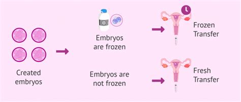 Embryo Transfer When And How Is It Done