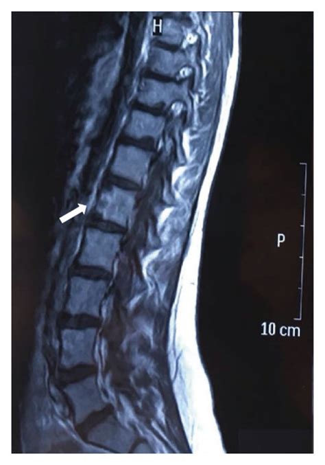 MRI Of The Dorsolumbar Spinal Cord A Sagittal Plane Of The Lumbar