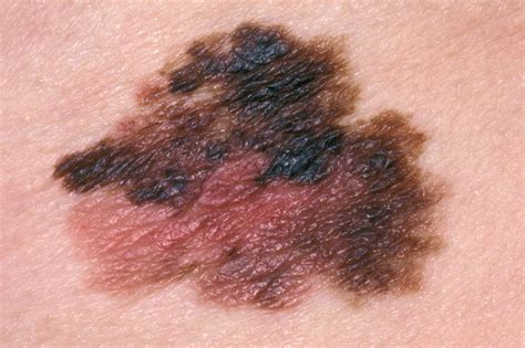 Skin Cancer Melanoma Nhs